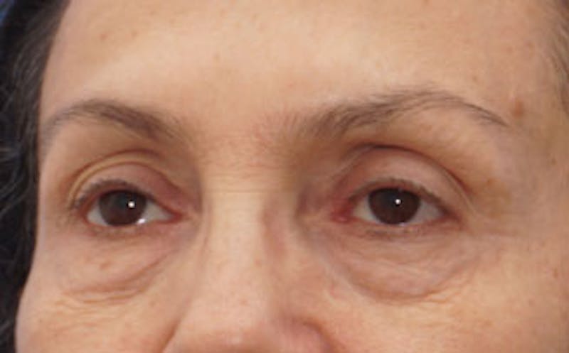 BOTOX Before & After Gallery - Patient 297943 - Image 5