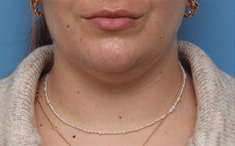 Patient RtuQxUYpT0Og-P0g03eMCw - FaceTite Before & After Photos