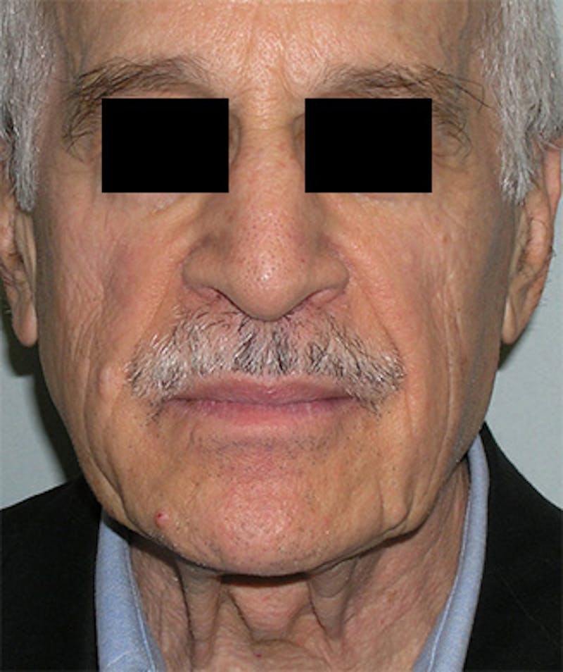 Facelift Before & After Gallery - Patient 217131 - Image 3