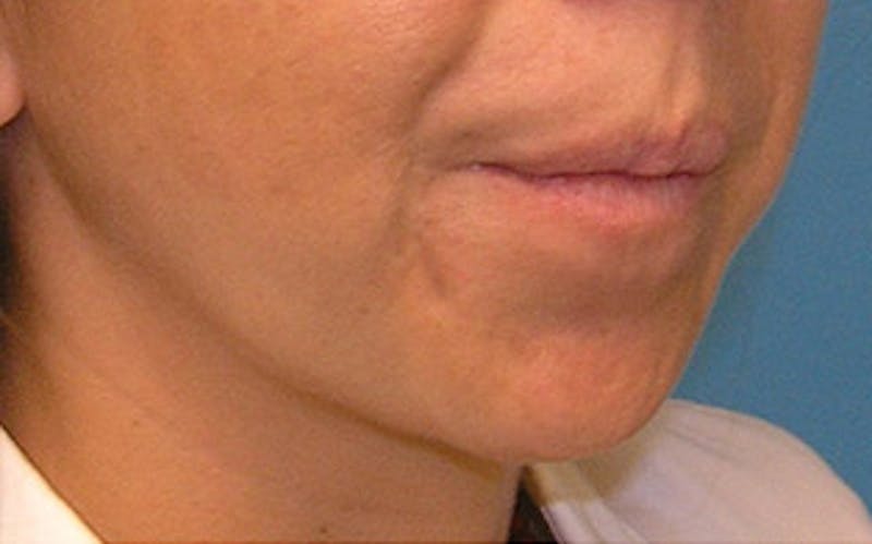Chin Surgery Before & After Gallery - Patient 400389 - Image 3