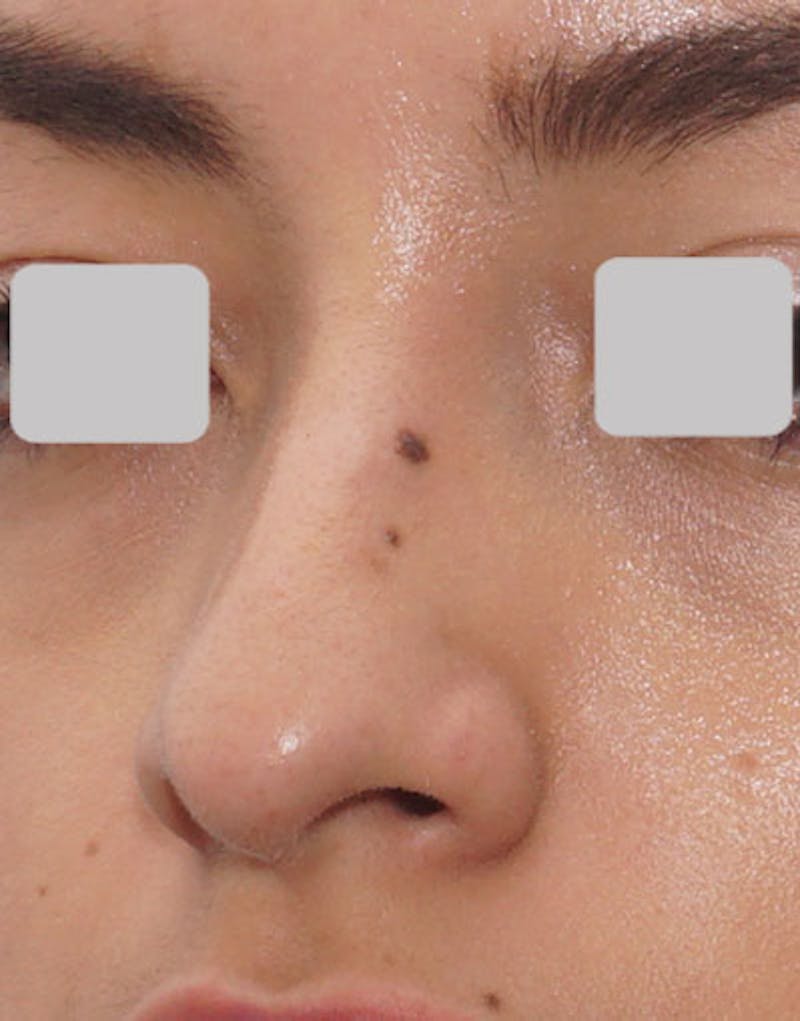 Rhinoplasty Before & After Gallery - Patient 247789 - Image 5