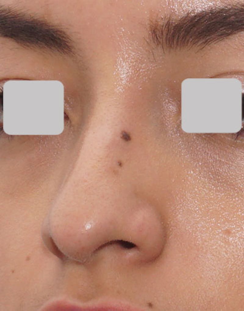 Rhinoplasty  Before & After Gallery - Patient 365447 - Image 5