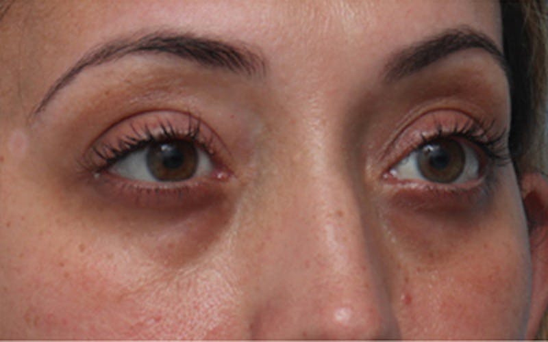 Fillers Before & After Gallery - Patient 408725 - Image 3