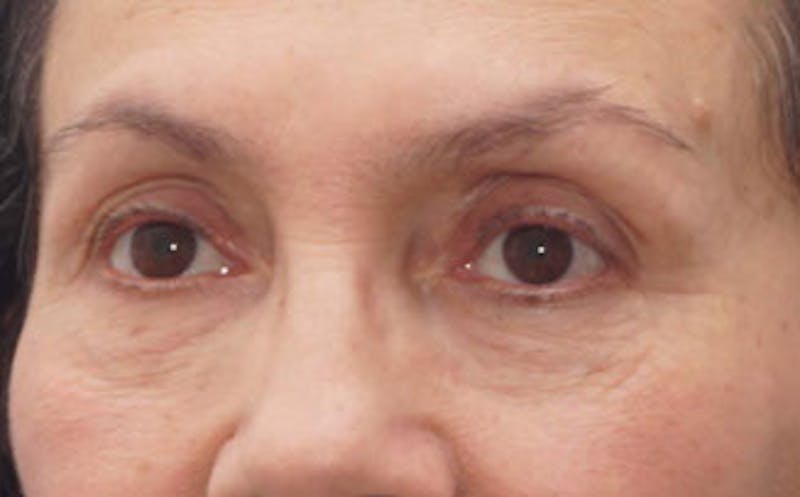 BOTOX Before & After Gallery - Patient 297943 - Image 6