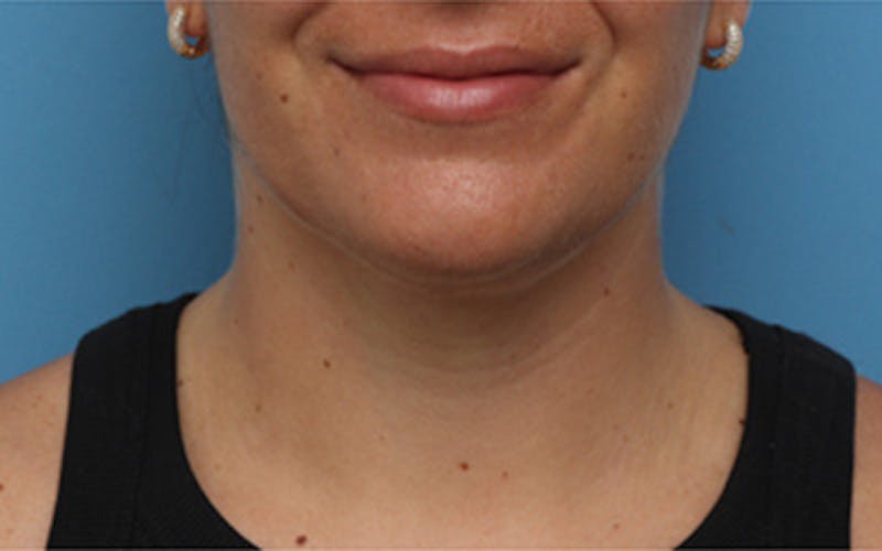 FaceTite Before & After Gallery - Patient 113176 - Image 2