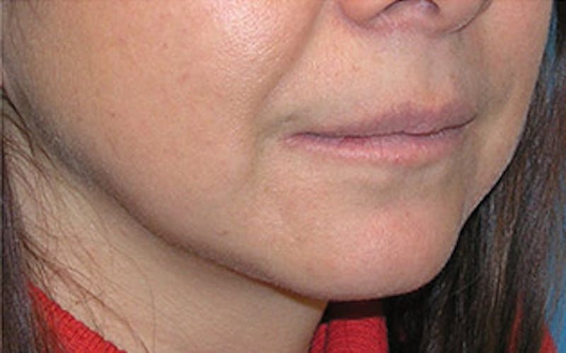Chin Surgery Before & After Gallery - Patient 400389 - Image 4