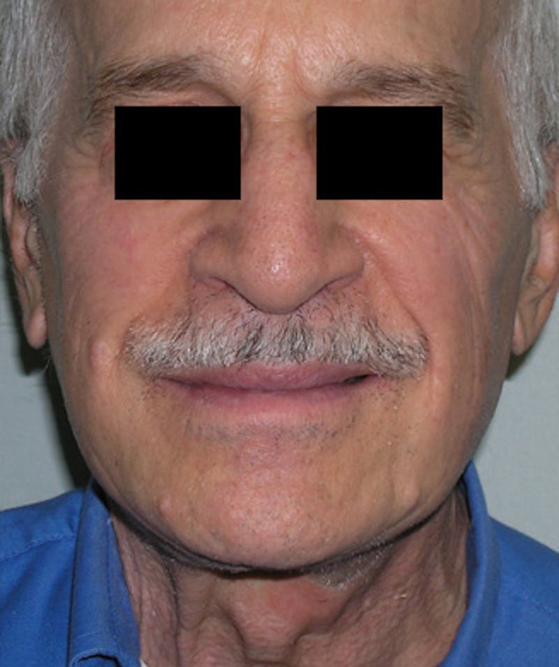Facelift Before & After Gallery - Patient 217131 - Image 4