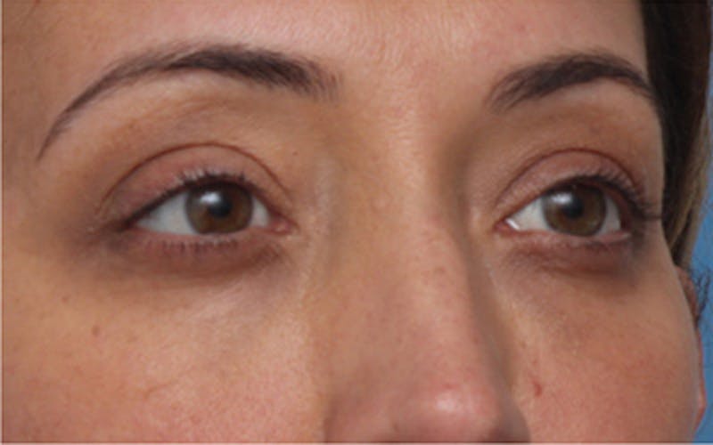 Fillers Before & After Gallery - Patient 408725 - Image 4