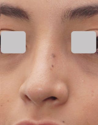 Favorite Ethnic Rhinoplasty Before & After Gallery - Patient 491007 - Image 6