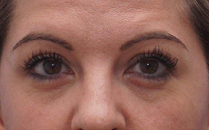 BOTOX Before & After Gallery - Patient 349427 - Image 1
