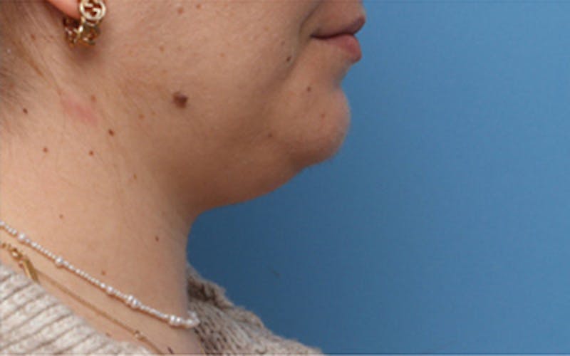 FaceTite Before & After Gallery - Patient 113176 - Image 3