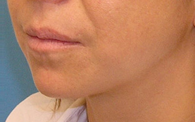 Chin Surgery Before & After Gallery - Patient 400389 - Image 5