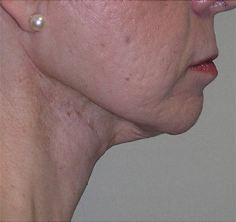 Facelift Before & After Gallery - Patient 409352 - Image 1