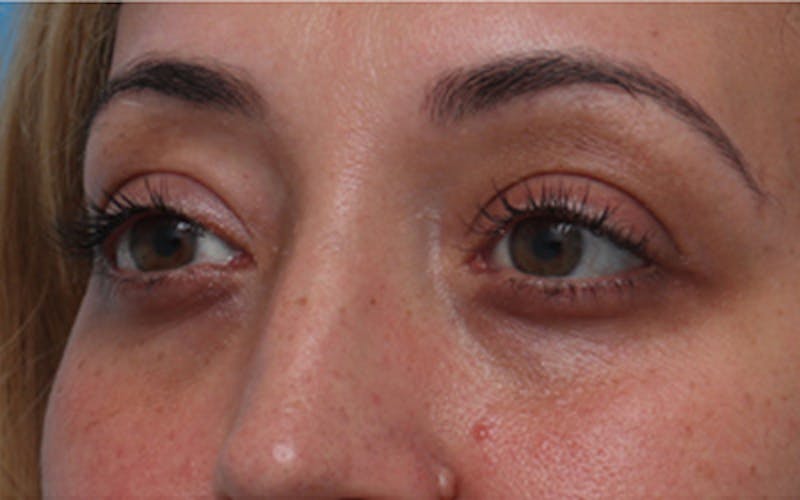Fillers Before & After Gallery - Patient 408725 - Image 5