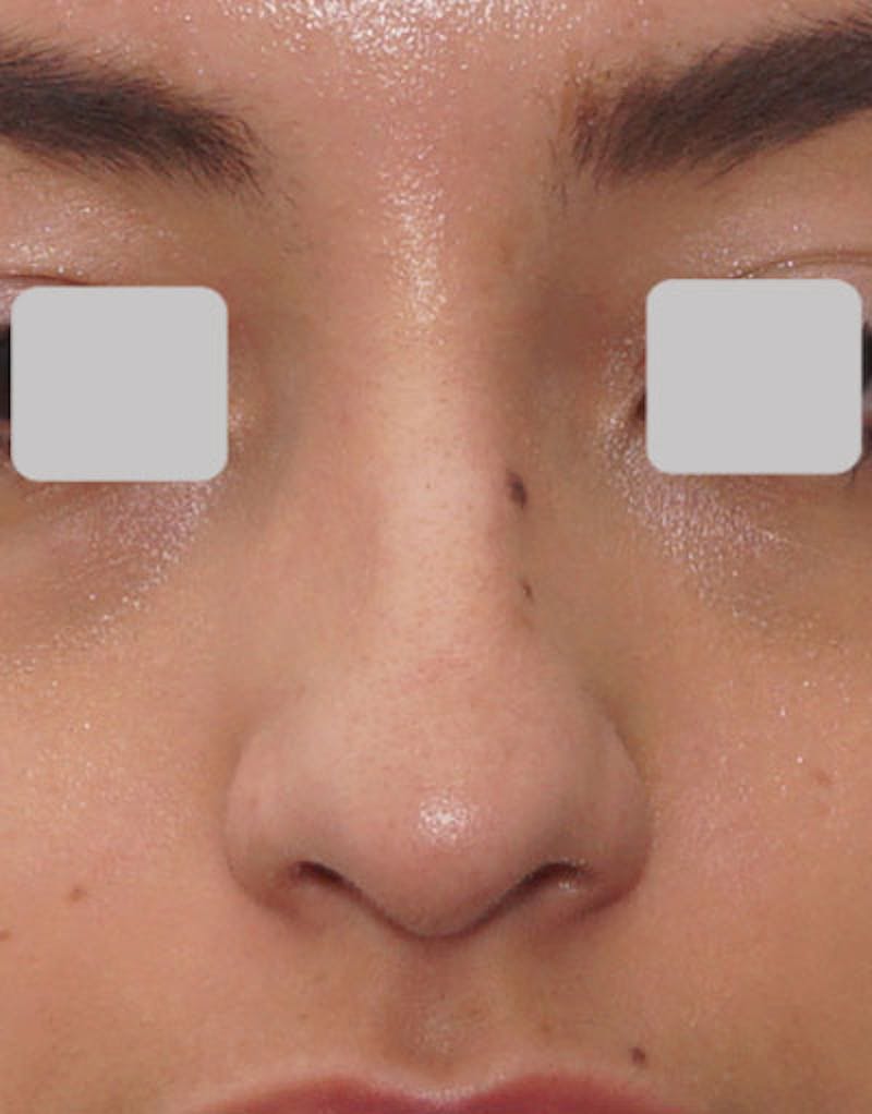 Rhinoplasty Before & After Gallery - Patient 247789 - Image 7
