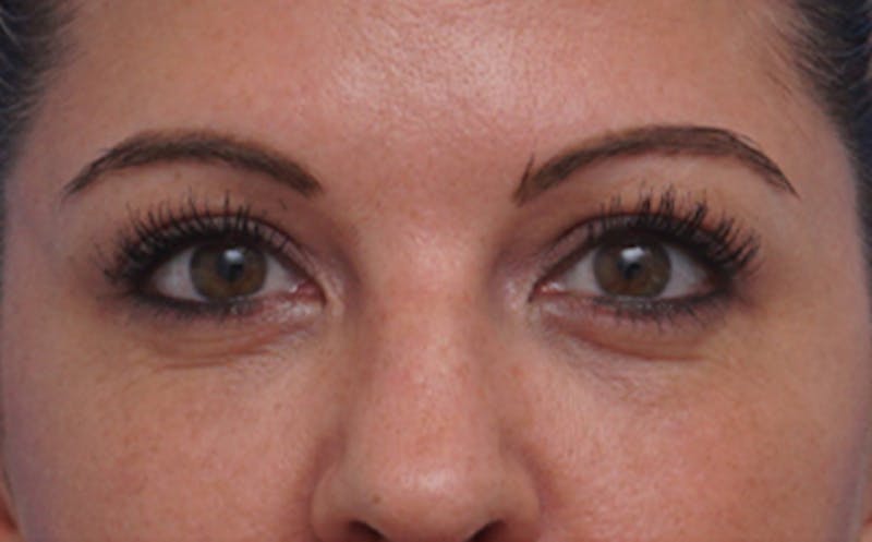 BOTOX Before & After Gallery - Patient 349427 - Image 2