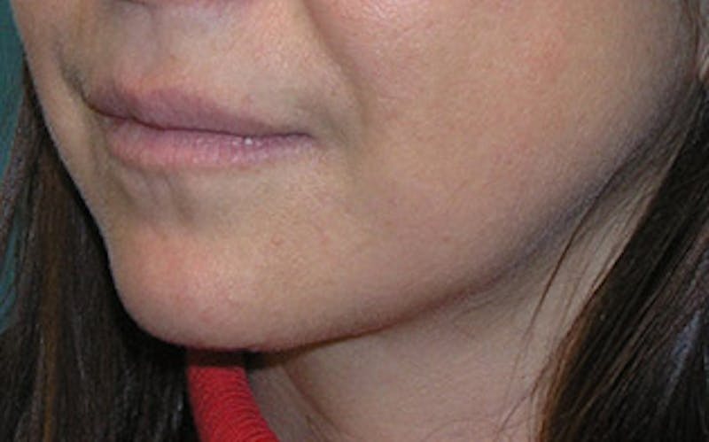 Chin Surgery Before & After Gallery - Patient 400389 - Image 6
