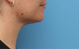 FaceTite Before & After Gallery - Patient 113176 - Image 4