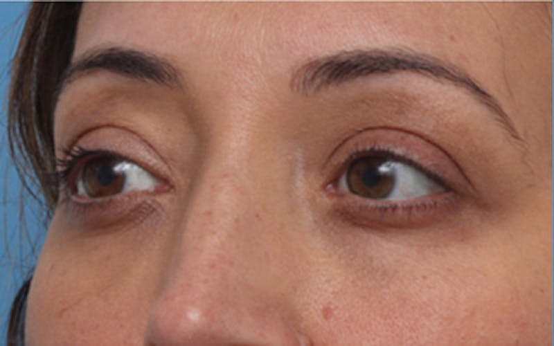 Fillers Before & After Gallery - Patient 408725 - Image 6