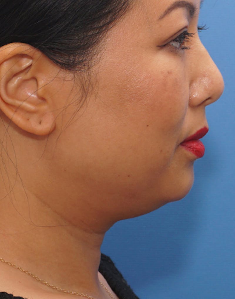 Jawline Contouring Before & After Gallery - Patient 302396 - Image 1