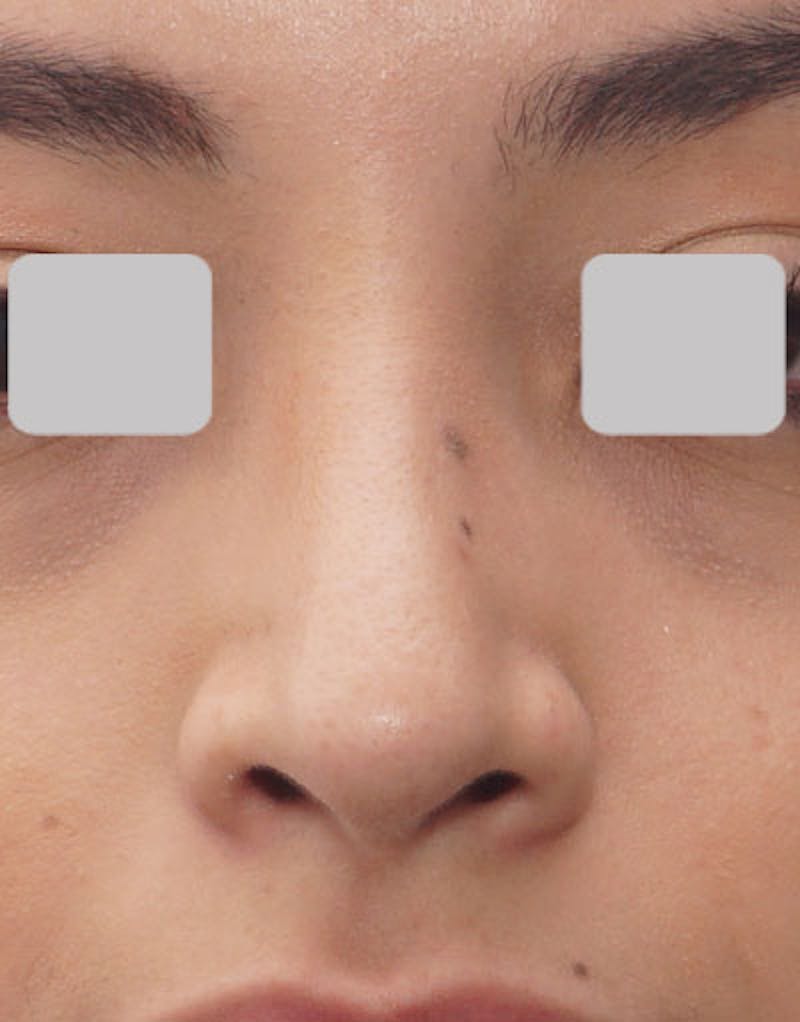 Rhinoplasty  Before & After Gallery - Patient 365447 - Image 8