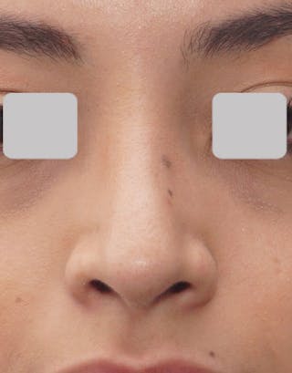 Favorite Ethnic Rhinoplasty Before & After Gallery - Patient 491007 - Image 8