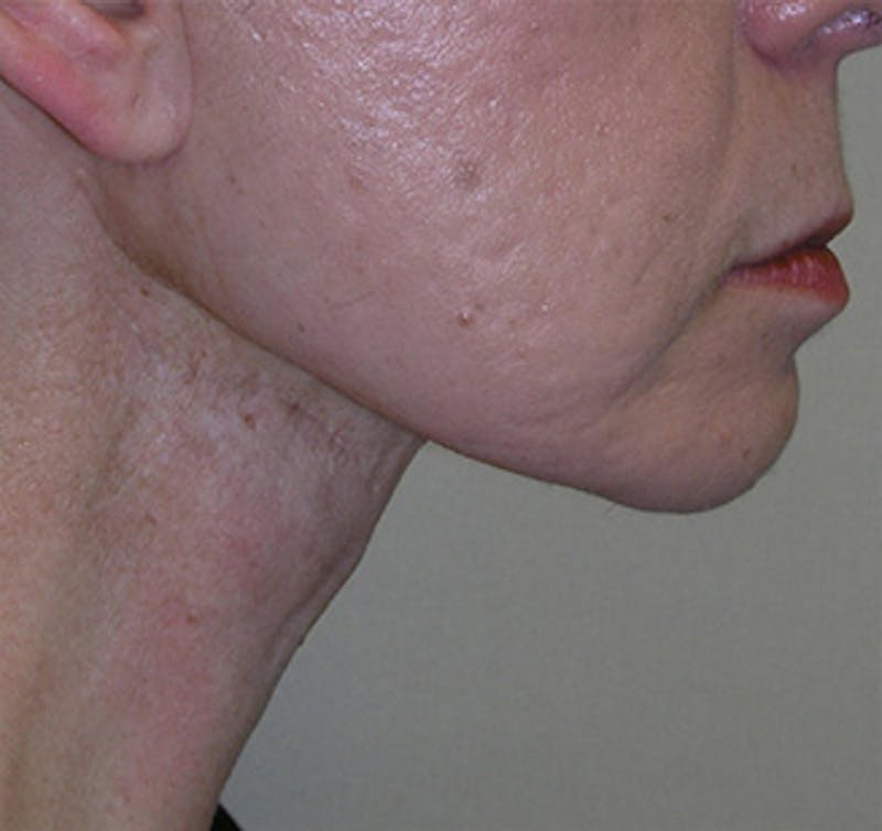 Facelift Before & After Gallery - Patient 409352 - Image 2