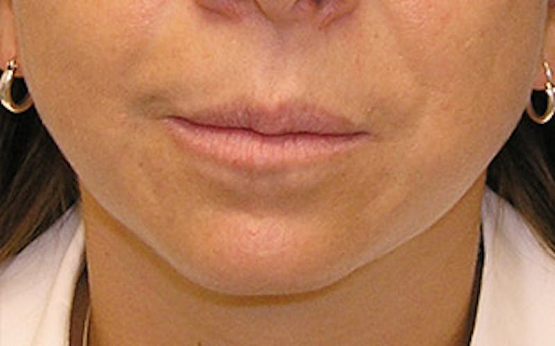Chin Surgery Before & After Gallery - Patient 400389 - Image 7