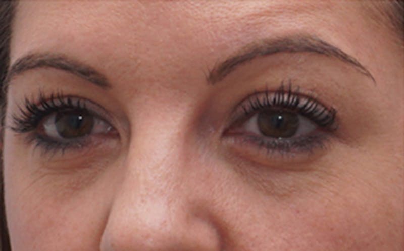 BOTOX Before & After Gallery - Patient 349427 - Image 3