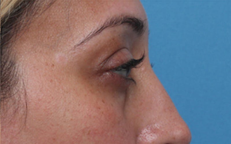 Fillers Before & After Gallery - Patient 408725 - Image 7