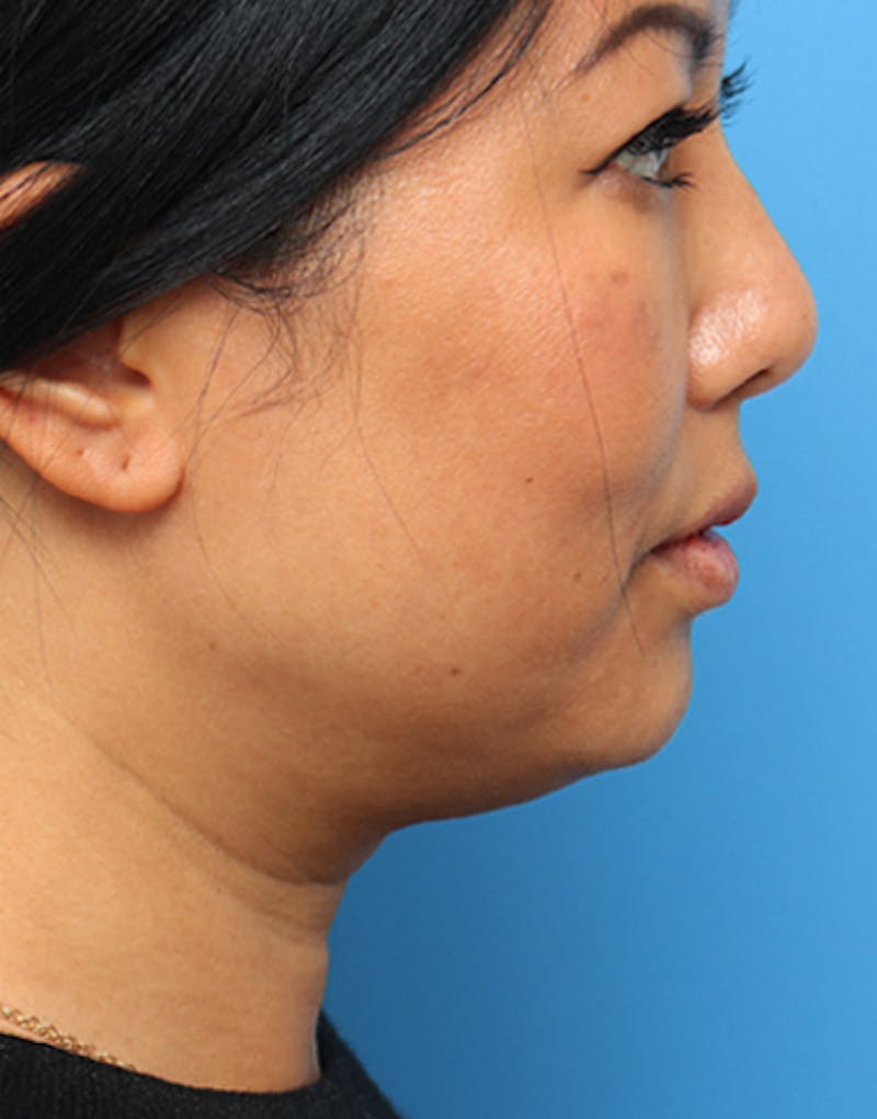 Jawline Contouring Before & After Gallery - Patient 302396 - Image 2