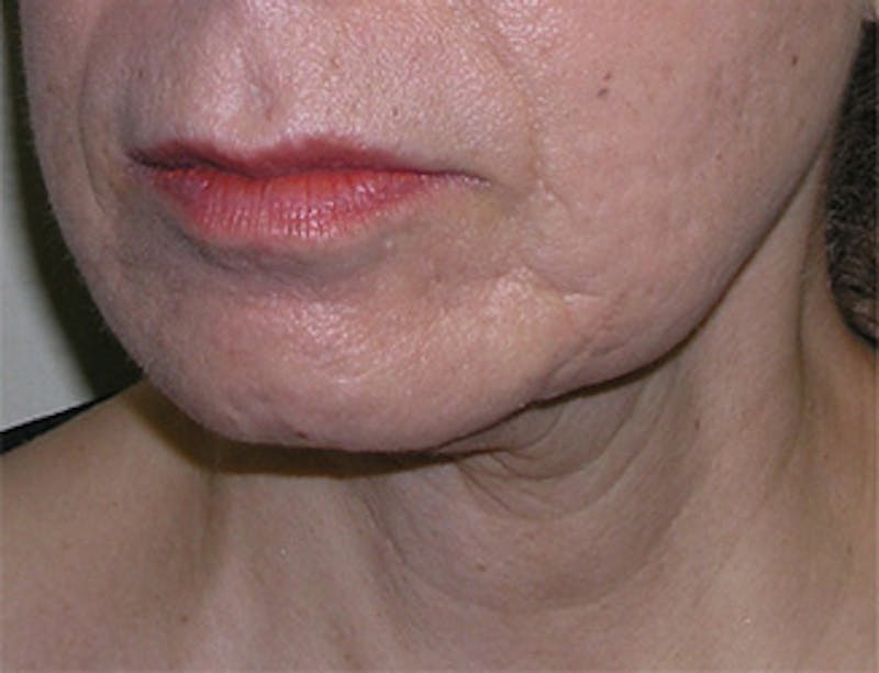 Facelift Before & After Gallery - Patient 409352 - Image 3