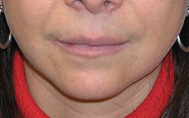 Chin Surgery Before & After Gallery - Patient 400389 - Image 8