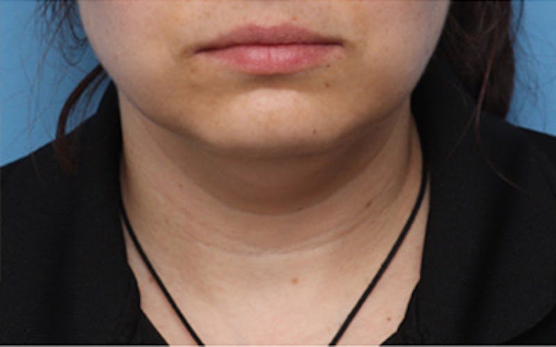 FaceTite Before & After Gallery - Patient 274120 - Image 1