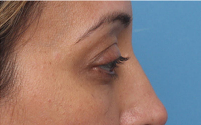 Fillers Before & After Gallery - Patient 408725 - Image 8