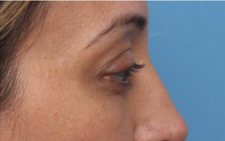 Fillers Before & After Gallery - Patient 408725 - Image 8