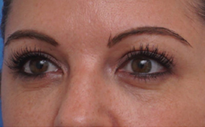 BOTOX Before & After Gallery - Patient 349427 - Image 4