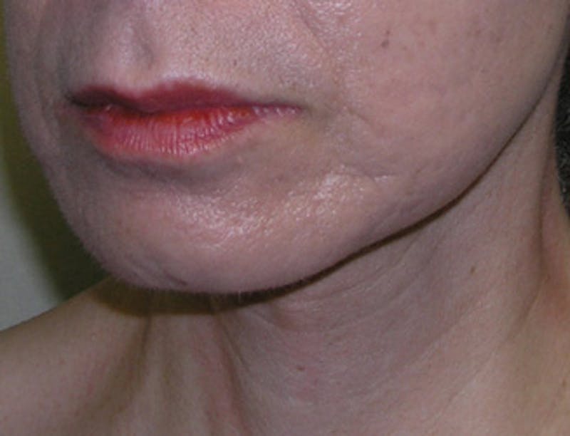 Facelift Before & After Gallery - Patient 409352 - Image 4