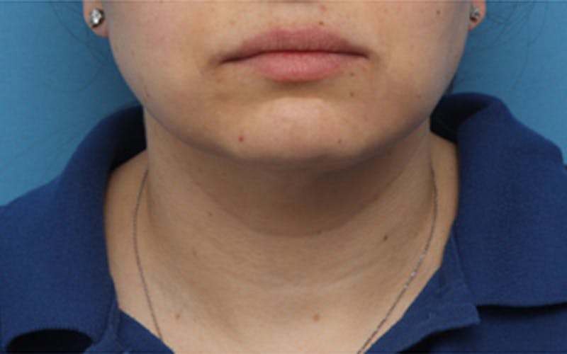FaceTite Before & After Gallery - Patient 274120 - Image 2