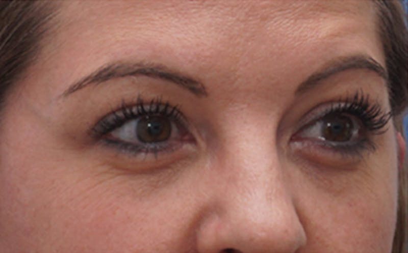 BOTOX Before & After Gallery - Patient 349427 - Image 5