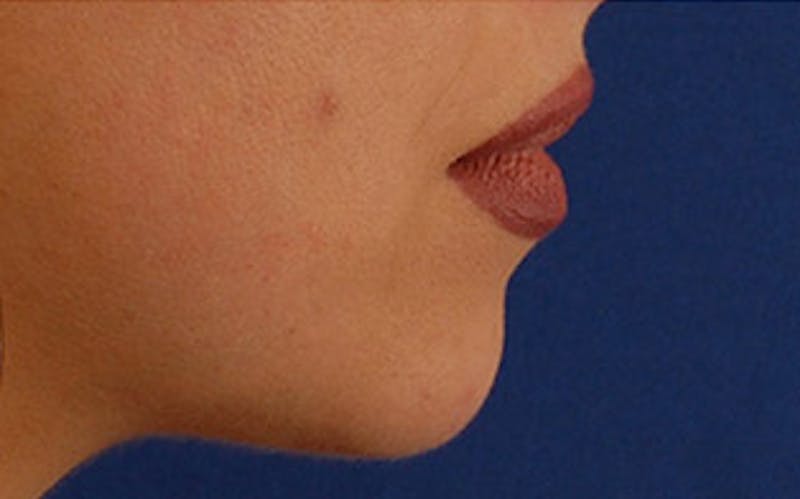 Chin Surgery Before & After Gallery - Patient 765705 - Image 1