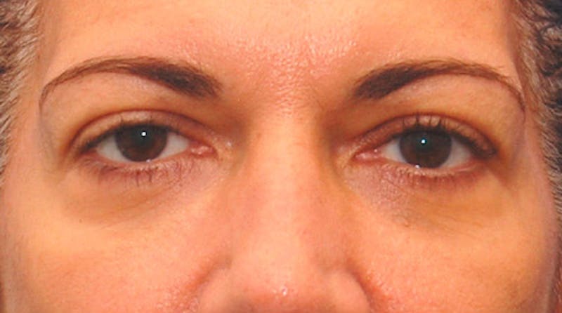 Fillers Before & After Gallery - Patient 229636 - Image 1