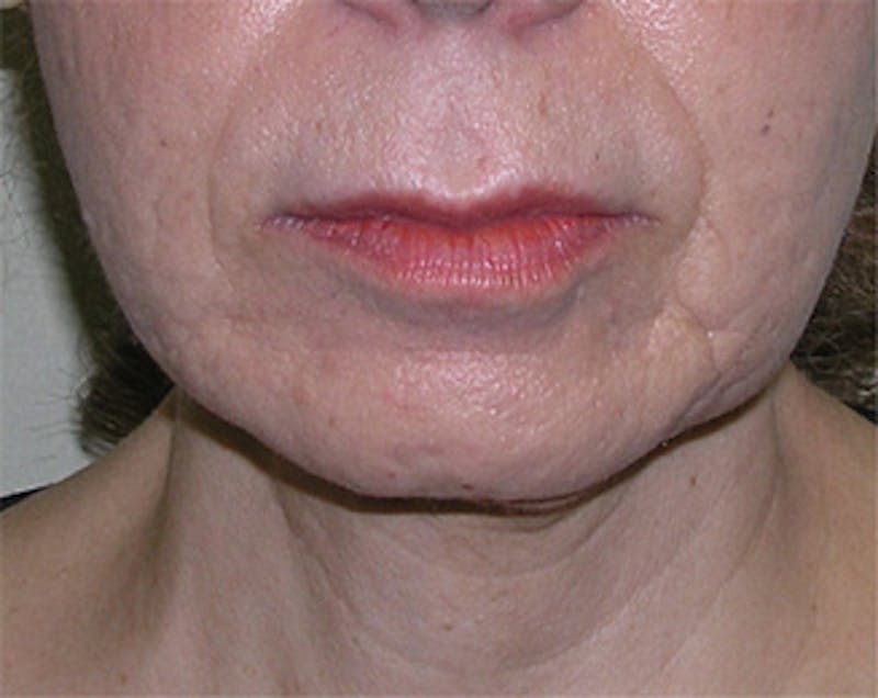 Facelift Before & After Gallery - Patient 409352 - Image 5