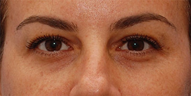 Eyelid Surgery Before & After Gallery - Patient 289046 - Image 1