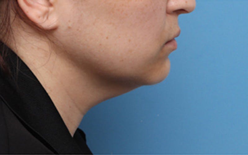 FaceTite Before & After Gallery - Patient 274120 - Image 3