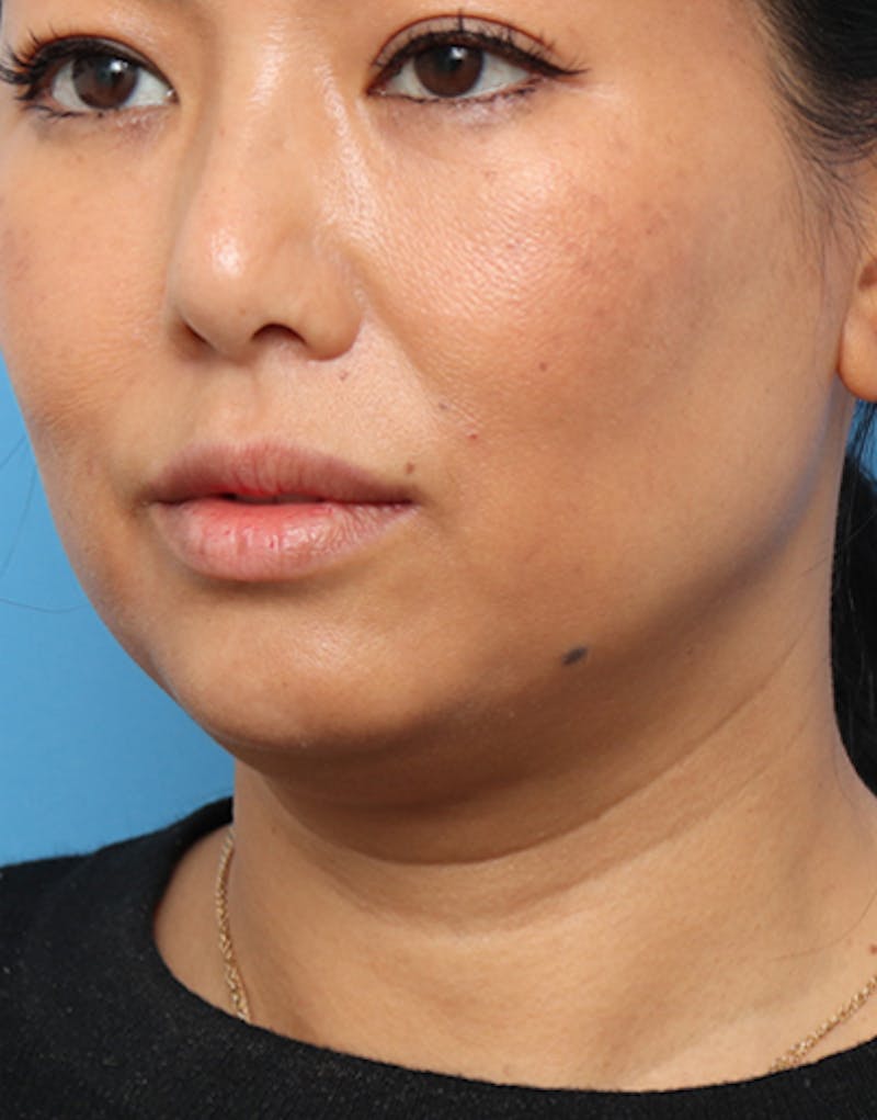 Jawline Contouring Before & After Gallery - Patient 302396 - Image 4