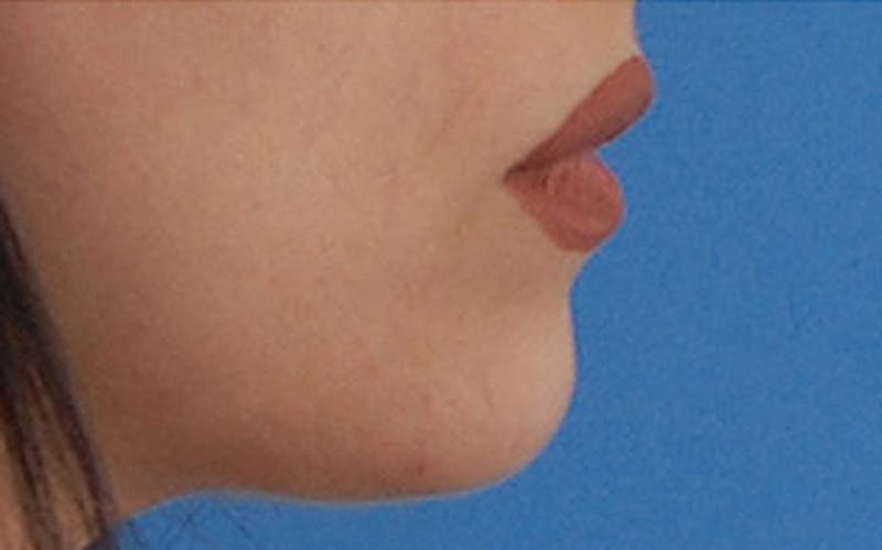 Chin Surgery Before & After Gallery - Patient 765705 - Image 2