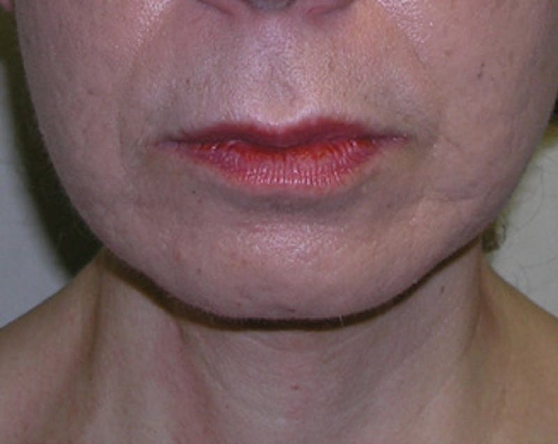 Facelift Before & After Gallery - Patient 409352 - Image 6