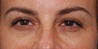 Eyelid Surgery Before & After Gallery - Patient 289046 - Image 2