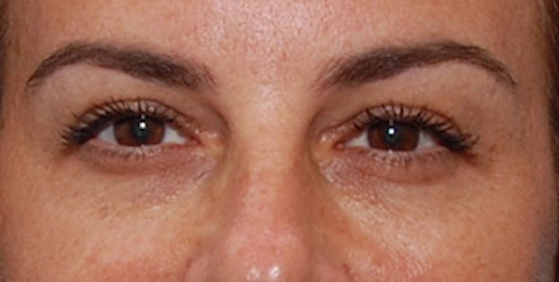 Eyelid Surgery Before & After Gallery - Patient 289046 - Image 2